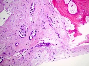 Metastasis