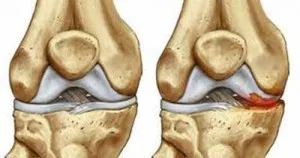 Dolor de rodillas 
