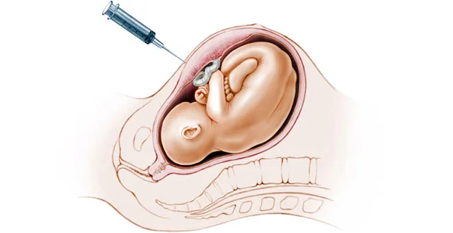 Amniocentesis
