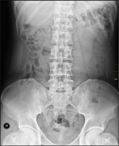 Hernia discal