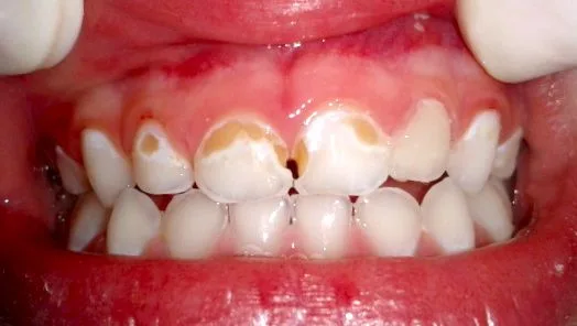 Una visita temprana al odontopediatra nos permitirá evitar caries infantiles tempranas