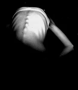 anorexia nerviosa