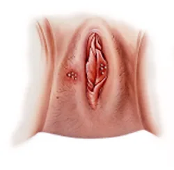 Herpes Genital