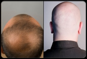 Alopecia: Perdida de cabello en hombres