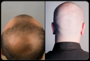 Alopecia: Perdida de cabello en hombres