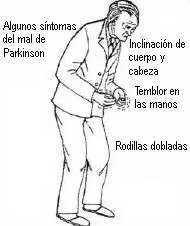 sintomas-del-parkinson