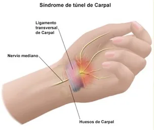 Tunel carpiano. Se me duerme la mano